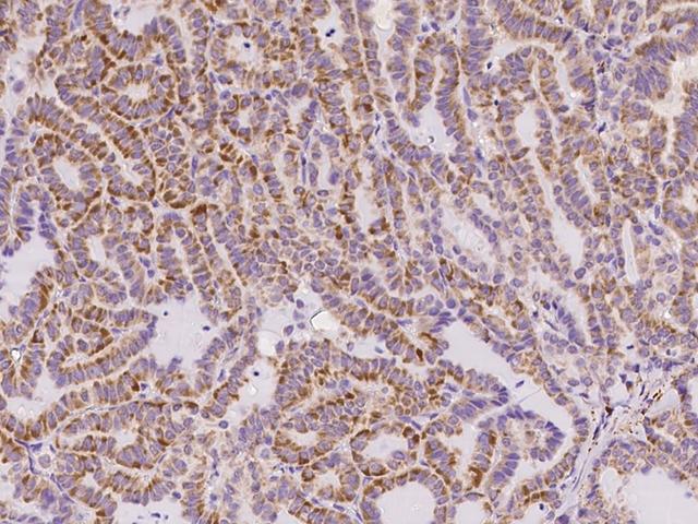 CD135 / FLT3 Antibody - Immunochemical staining of human FLT3 in human thyroid carcinoma with rabbit polyclonal antibody at 1:500 dilution, formalin-fixed paraffin embedded sections.