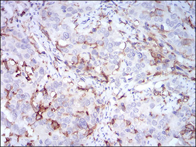 CD14 Antibody - IHC of paraffin-embedded cervical cancer tissues using CD14 mouse monoclonal antibody with DAB staining.