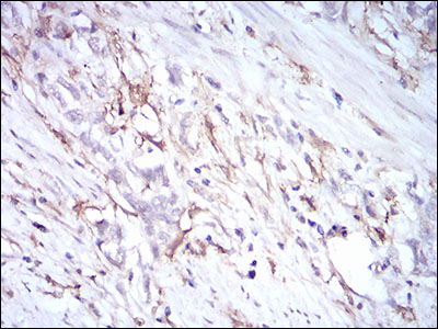 CD14 Antibody - IHC of paraffin-embedded stomach cancer tissues using CD14 mouse monoclonal antibody with DAB staining.