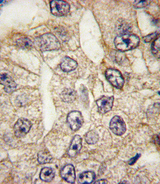 CD14 Antibody - Formalin-fixed and paraffin-embedded human lung carcinoma tissue reacted with CD14 antibody , which was peroxidase-conjugated to the secondary antibody, followed by DAB staining. This data demonstrates the use of this antibody for immunohistochemistry; clinical relevance has not been evaluated.