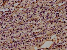 CD14 Antibody - IHC diluted at 1:100 and staining in paraffin-embedded human lung cancer.
