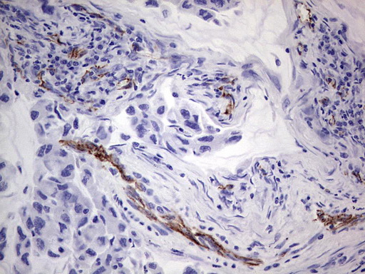 CD144 / CDH5 / VE Cadherin Antibody - Immunohistochemical staining of paraffin-embedded Carcinoma of Human lung tissue using anti-CDH5 mouse monoclonal antibody. (Heat-induced epitope retrieval by 1 mM EDTA in 10mM Tris, pH8.5, 120C for 3min,