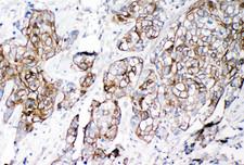 CD144 / CDH5 / VE Cadherin Antibody - CD144 / CDH5 / VE Cadherin antibody. IHC(P): Human Lung Cancer Tissue.