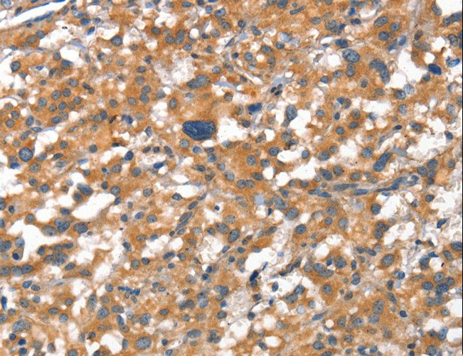 CD144 / CDH5 / VE Cadherin Antibody - Immunohistochemistry of paraffin-embedded Human gastric cancer using CDH5 Polyclonal Antibody at dilution of 1:50.