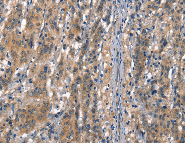 CD144 / CDH5 / VE Cadherin Antibody - Immunohistochemistry of paraffin-embedded Human gastric cancer using CDH5 Polyclonal Antibody at dilution of 1:50.