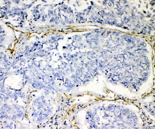 CD144 / CDH5 / VE Cadherin Antibody - IHC analysis of VE Cadherin using anti-VE Cadherin antibody. VE Cadherin was detected in paraffin-embedded section of human lung cancer tissue. Heat mediated antigen retrieval was performed in citrate buffer (pH6, epitope retrieval solution) for 20 mins. The tissue section was blocked with 10% goat serum. The tissue section was then incubated with 1ugµg/ml rabbit anti-VE Cadherin Antibody overnight at 4°C. Biotinylated goat anti-rabbit IgG was used as secondary antibody and incubated for 30 minutes at 37°C. The tissue section was developed using Strepavidin-Biotin-Complex (SABC) with DAB as the chromogen.