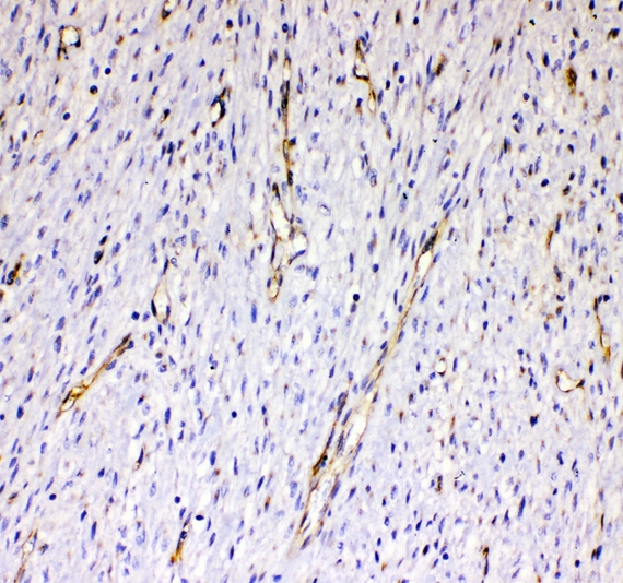 CD144 / CDH5 / VE Cadherin Antibody - IHC analysis of VE Cadherin using anti-VE Cadherin antibody. VE Cadherin was detected in paraffin-embedded section of human mammary cancer tissue. Heat mediated antigen retrieval was performed in citrate buffer (pH6, epitope retrieval solution) for 20 mins. The tissue section was blocked with 10% goat serum. The tissue section was then incubated with 1ugµg/ml rabbit anti-VE Cadherin Antibody overnight at 4°C. Biotinylated goat anti-rabbit IgG was used as secondary antibody and incubated for 30 minutes at 37°C. The tissue section was developed using Strepavidin-Biotin-Complex (SABC) with DAB as the chromogen.
