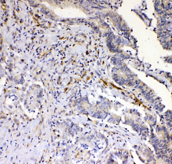 CD144 / CDH5 / VE Cadherin Antibody - IHC analysis of VE Cadherin using anti-VE Cadherin antibody. VE Cadherin was detected in paraffin-embedded section of human rectal cancer tissue. Heat mediated antigen retrieval was performed in citrate buffer (pH6, epitope retrieval solution) for 20 mins. The tissue section was blocked with 10% goat serum. The tissue section was then incubated with 1ugµg/ml rabbit anti-VE Cadherin Antibody overnight at 4°C. Biotinylated goat anti-rabbit IgG was used as secondary antibody and incubated for 30 minutes at 37°C. The tissue section was developed using Strepavidin-Biotin-Complex (SABC) with DAB as the chromogen.