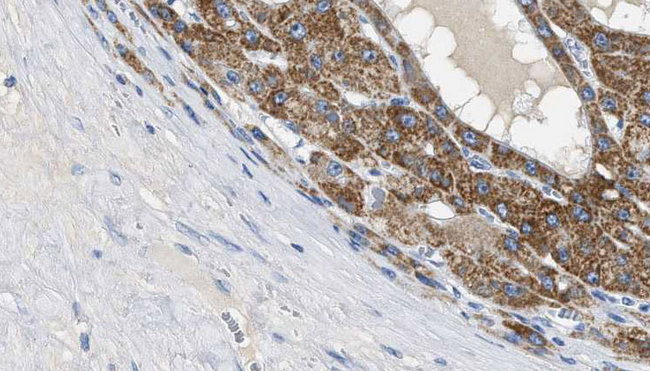 CD144 / CDH5 / VE Cadherin Antibody - 1:100 staining human liver carcinoma tissues by IHC-P. The sample was formaldehyde fixed and a heat mediated antigen retrieval step in citrate buffer was performed. The sample was then blocked and incubated with the antibody for 1.5 hours at 22°C. An HRP conjugated goat anti-rabbit antibody was used as the secondary.