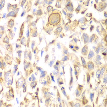 CD151 Antibody - Immunohistochemistry of paraffin-embedded human lung cancer tissue.