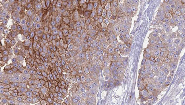 CD151 Antibody - 1:100 staining human urothelial carcinoma tissue by IHC-P. The sample was formaldehyde fixed and a heat mediated antigen retrieval step in citrate buffer was performed. The sample was then blocked and incubated with the antibody for 1.5 hours at 22°C. An HRP conjugated goat anti-rabbit antibody was used as the secondary.