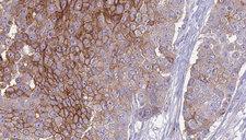 CD151 Antibody - 1:100 staining human urothelial carcinoma tissue by IHC-P. The sample was formaldehyde fixed and a heat mediated antigen retrieval step in citrate buffer was performed. The sample was then blocked and incubated with the antibody for 1.5 hours at 22°C. An HRP conjugated goat anti-rabbit antibody was used as the secondary.