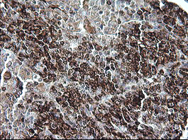 CD163 Antibody - IHC of paraffin-embedded Human lymphoma tissue using anti-CD163 mouse monoclonal antibody. (Heat-induced epitope retrieval by 10mM citric buffer, pH6.0, 120°C for 3min).