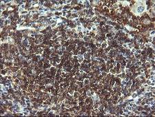 CD19 Antibody - IHC of paraffin-embedded Human lymphoma tissue using anti-CD19 mouse monoclonal antibody. (Heat-induced epitope retrieval by 10mM citric buffer, pH6.0, 120°C for 3min).