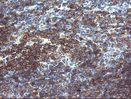 CD19 Antibody - IHC of paraffin-embedded Human lymphoma tissue using anti-CD19 mouse monoclonal antibody.