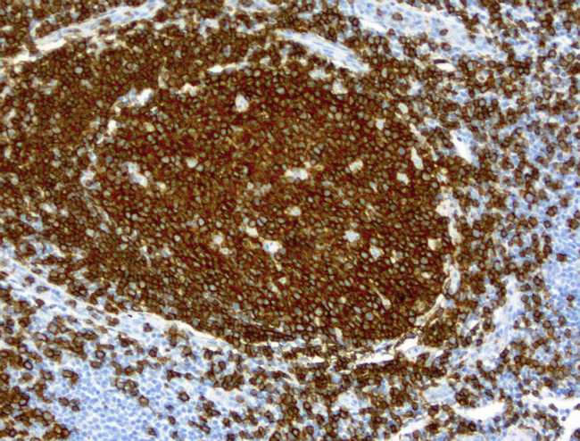CD19 Antibody - Immunohistochemical staining of paraffin-embedded human tonsil using anti-CD19 clone UMAB103 mouse monoclonal antibody at 1:200 dilution of 0.6mg/mL and detection with Polink2 Broad HRP DAB.requires heat-induced epitope retrieval with citrate pH6.0 at 95-100C 20 minutes.. The image shows strong membranous and cytoplasmic staining in >40 % of non germinal center cells of tonsil and >90% of the germinal center cells. No staining was seen in the squamous epithelia cells.