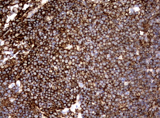 CD19 Antibody - Immunohistochemical staining of paraffin-embedded Human lymph node tissue using anti-CD19 mouse monoclonal antibody.  heat-induced epitope retrieval by 10mM citric buffer, pH6.0, 120C for 3min)
