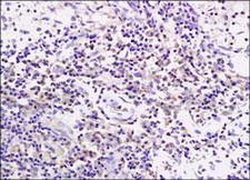 CD19 Antibody - Paraffin-embedded rat tumor tissue is stained with CD19 Antibody used at 1:200 dilution.