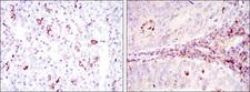 CD1A Antibody - IHC of paraffin-embedded cervical cancer tissues (left) and colon cancer tissues (right) using CD1A mouse monoclonal antibody with DAB staining.
