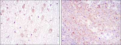 CD1A Antibody - IHC of paraffin-embedded brain tissues (left) and submaxillary tumor tissues (right) using CD1A mouse monoclonal antibody with DAB staining.