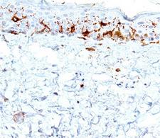 CD1A Antibody - CD1a antibody immunohistochemistry.  This image was taken for the unmodified form of this product. Other forms have not been tested.