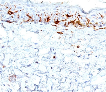 CD1A Antibody - CD1a antibody immunohistochemistry.  This image was taken for the unmodified form of this product. Other forms have not been tested.