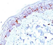 CD1A Antibody - CD1a antibody O10 immunohistochemistry.  This image was taken for the unmodified form of this product. Other forms have not been tested.