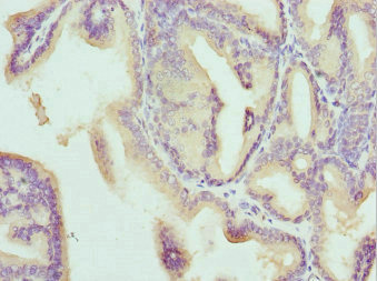 CD1B Antibody - Immunohistochemistry of paraffin-embedded human prostate cancer at dilution 1:100