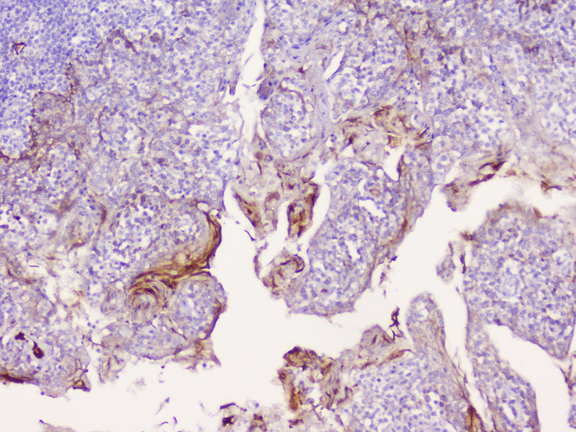 CD1B Antibody - IHC analysis of CD1b using anti-CD1b antibody. CD1b was detected in paraffin-embedded section of human tonsil tissue. Heat mediated antigen retrieval was performed in citrate buffer (pH6, epitope retrieval solution) for 20 mins. The tissue section was blocked with 10% goat serum. The tissue section was then incubated with 1µg/ml rabbit anti-CD1b Antibody overnight at 4°C. Biotinylated goat anti-rabbit IgG was used as secondary antibody and incubated for 30 minutes at 37°C. The tissue section was developed using Strepavidin-Biotin-Complex (SABC) with DAB as the chromogen.