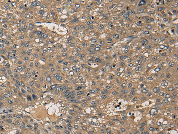 CD1B Antibody - Immunohistochemistry of paraffin-embedded Human liver cancer tissue  using CD1B Polyclonal Antibody at dilution of 1:55(×200)