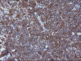 CD1C Antibody - IHC of paraffin-embedded Human lymphoma tissue using anti-CD1C mouse monoclonal antibody.