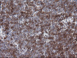 CD1C Antibody - IHC of paraffin-embedded Human lymphoma tissue using anti-CD1C mouse monoclonal antibody. (Heat-induced epitope retrieval by 10mM citric buffer, pH6.0, 100C for 10min).