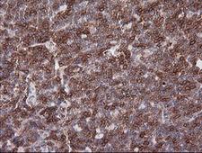 CD1C Antibody - IHC of paraffin-embedded Human lymphoma tissue using anti-CD1C mouse monoclonal antibody. (Heat-induced epitope retrieval by 10mM citric buffer, pH6.0, 100C for 10min).