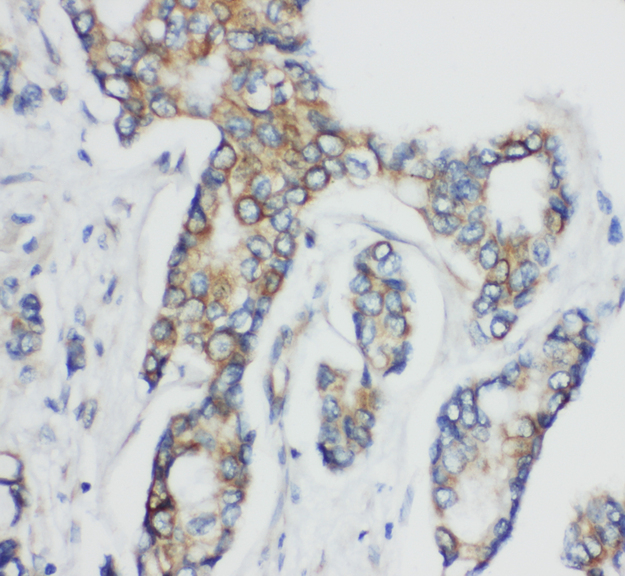 CD1D Antibody - CD1D antibody. IHC(P): Human Breast Cancer Tissue.