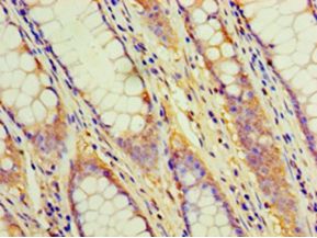 CD2 Antibody - Immunohistochemistry of paraffin-embedded human colon cancer tissue using antibody at 1:100 dilution.  This image was taken for the unconjugated form of this product. Other forms have not been tested.