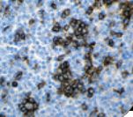CD2 Antibody - IHC of CD2 on FFPE T-Cell Lymphoma tissue.