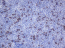 CD2 Antibody - IHC of paraffin-embedded Human lymphoma tissue using anti-CD2 mouse monoclonal antibody. (Heat-induced epitope retrieval by 10mM citric buffer, pH6.0, 120°C for 3min).