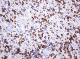 CD2 Antibody - IHC of paraffin-embedded Human lymphoma tissue using anti-CD2 mouse monoclonal antibody.