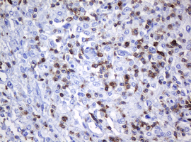 CD2 Antibody - IHC of paraffin-embedded Human lymphoma tissue using anti-CD2 mouse monoclonal antibody.