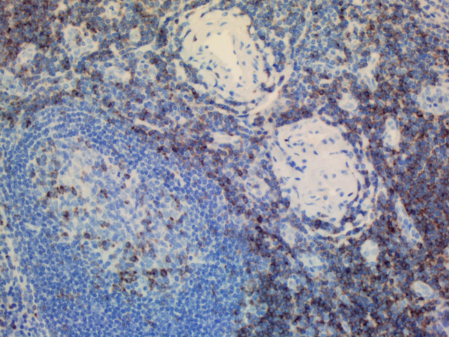 CD2 Antibody - IHC staining of paraffin-embedded human tonsil using anti-CD2 clone UMAB6 mouse monoclonal antibody at 1:200 of 0.6mg/mL and detection with Polink2 Broad HRP DAB.requires heat-induced epitope retrieval with Accel pH8.7 at 95-100C 30 minutes [do not let boil] or 10 min in pressure cooker. The image shows strong membranous and cytoplasmic staining in >50 % of non germinal center cells of tonsil and <20% of the germinal center cells. No staining was seen in the squamous epithelia cells.