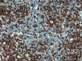 CD2 Antibody - Immunohistochemical staining of paraffin-embedded Human lymphoma tissue using anti-CD2 mouse monoclonal antibody. (Clone UMAB6, dilution 1:100; heat-induced epitope retrieval by 10mM citric buffer, pH6.0, 120C for 3min)