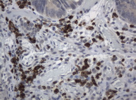 CD2 Antibody - Immunohistochemical staining of paraffin-embedded Adenocarcinoma of colon tissue using anti-CD2 mouse monoclonal antibody. (Clone UMAB6, dilution 1:100; heat-induced epitope retrieval by 10mM citric buffer, pH6.0, 120C for 3min)