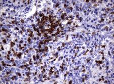 CD2 Antibody - Immunohistochemical staining of paraffin-embedded Carcinoma of Human lung tissue using anti-CD2 mouse monoclonal antibody.  heat-induced epitope retrieval by 10mM citric buffer, pH6.0, 120C for 3min)