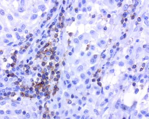 CD2 Antibody - Immunohistochemical staining of paraffin-embedded human melanoma using anti-CD2 mouse monoclonal antibody at 1: 200 dilution of 1mg/mL using Polink2 Broad HRP DAB for detection.requires HIER with citrate pH6.0 at 110C for 3 min using pressure chamber/cooker. The image shows strong cytoplamic and membrane staining infiltrating T cells but no staining in the tumor cells..