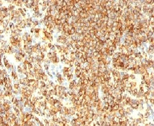 CD20 Antibody - IHC testing of CD20 antibody and human lymphoma tissue.  This image was taken for the unmodified form of this product. Other forms have not been tested.