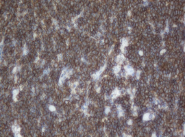 CD20 Antibody - IHC of paraffin-embedded Human lymphoma tissue using anti-MS4A1 mouse monoclonal antibody. (Heat-induced epitope retrieval by 10mM citric buffer, pH6.0, 100C for 10min).