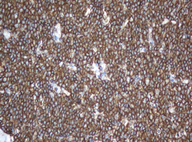 CD20 Antibody - IHC of paraffin-embedded Human lymphoma tissue using anti-MS4A1 mouse monoclonal antibody.