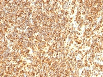 CD20 Antibody - IHC testing of CD20 antibody and human lymphoma tissue.  This image was taken for the unmodified form of this product. Other forms have not been tested.
