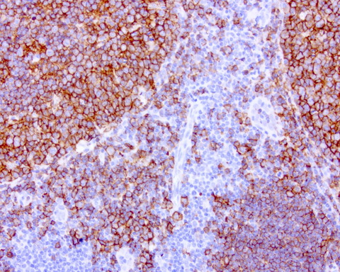 CD20 Antibody - Immunohistochemical staining of paraffin-embedded human tonsil using anti-CD20 mouse monoclonal antibody at 1:200 dilution of 1.0 mg/mL using Polink2 Broad HRP DAB for detection.requires HIER with with citrate pH6.0 at 110C for 3 min using pressure chamber/cooker. The tonsil shows strong membrane and cytoplasmic staining in the germinal center of the tonsil and some poitive cells in the non-germinal center.