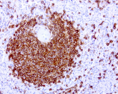 CD20 Antibody - Immunohistochemical staining of paraffin-embedded human spleen using anti-CD20 mouse monoclonal antibody at 1:200 dilution of 1.0 mg/mL using Polink2 Broad HRP DAB for detection.requires HIER with with citrate pH6.0 at 110C for 3 min using pressure chamber/cooker. The spleen shows strong membrane and cytoplasmic staining in red and white pulp cells.